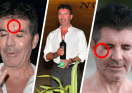 Simon Cowell’s Frequent Injuries: Another Black Eye Raises Concern
