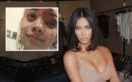 Kim Kardashian Offers To Help Teen Girl Shot With Rubber Bullet In The Face During Protests