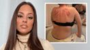 Ashley Graham Shows Bruises On Her Back — How Did She Get Them?